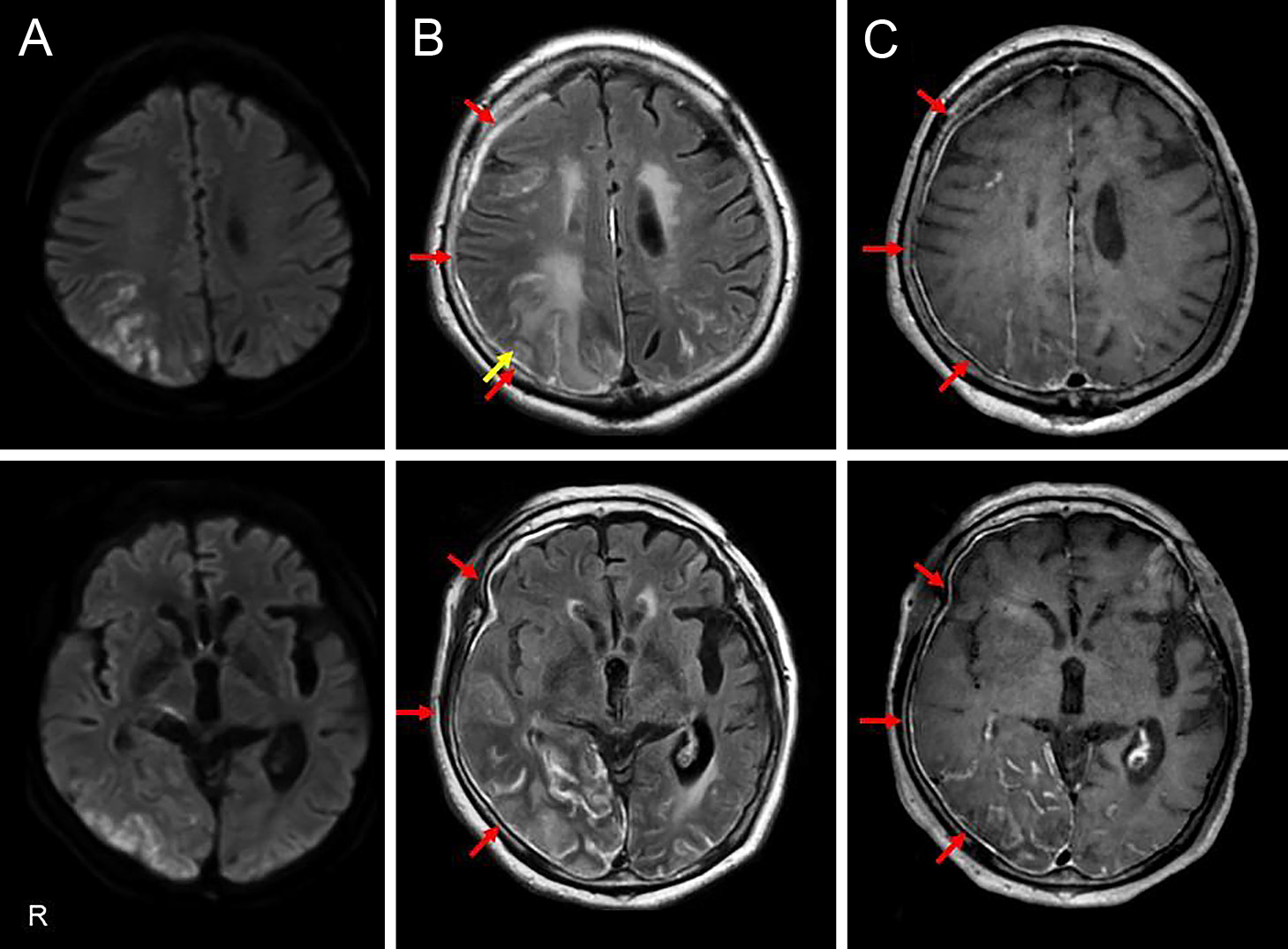 硬膜造影効果を伴ったアミロイドβ関連血管炎（ABRA）の1例