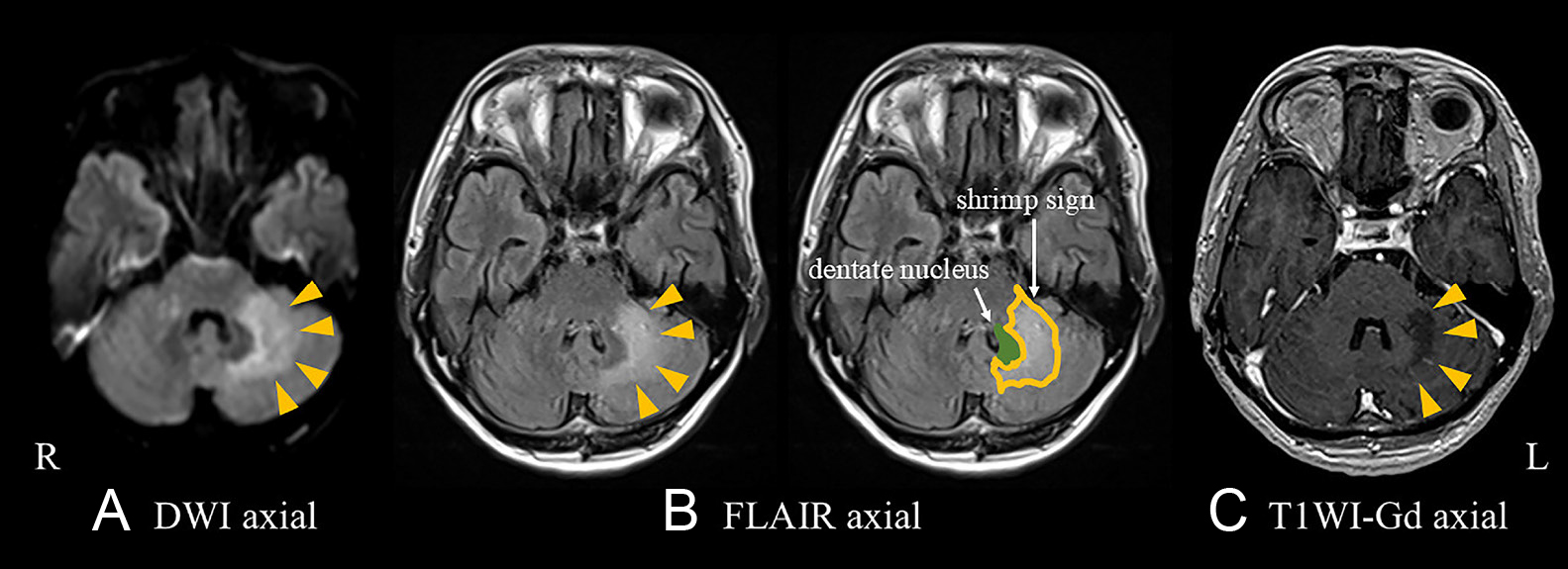 Shrimp signが診断に有用であった小脳限局型HIV関連進行性多巣性白質脳症の1例