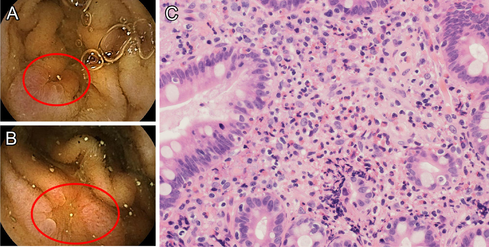 多発単神経炎と消化管出血を呈し早期メポリズマブ導入が奏効した好酸球性多発血管炎性肉芽腫症の1例