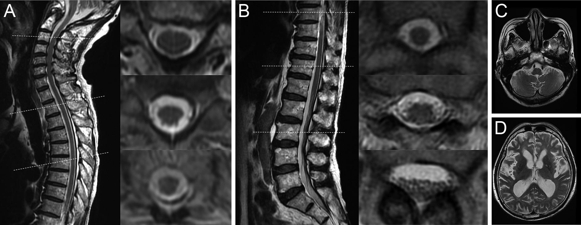 脊髄MRIや髄液検査で異常を認めなかった抗myelin-oligodendrocyte glycoprotein（MOG）抗体関連疾患の1例