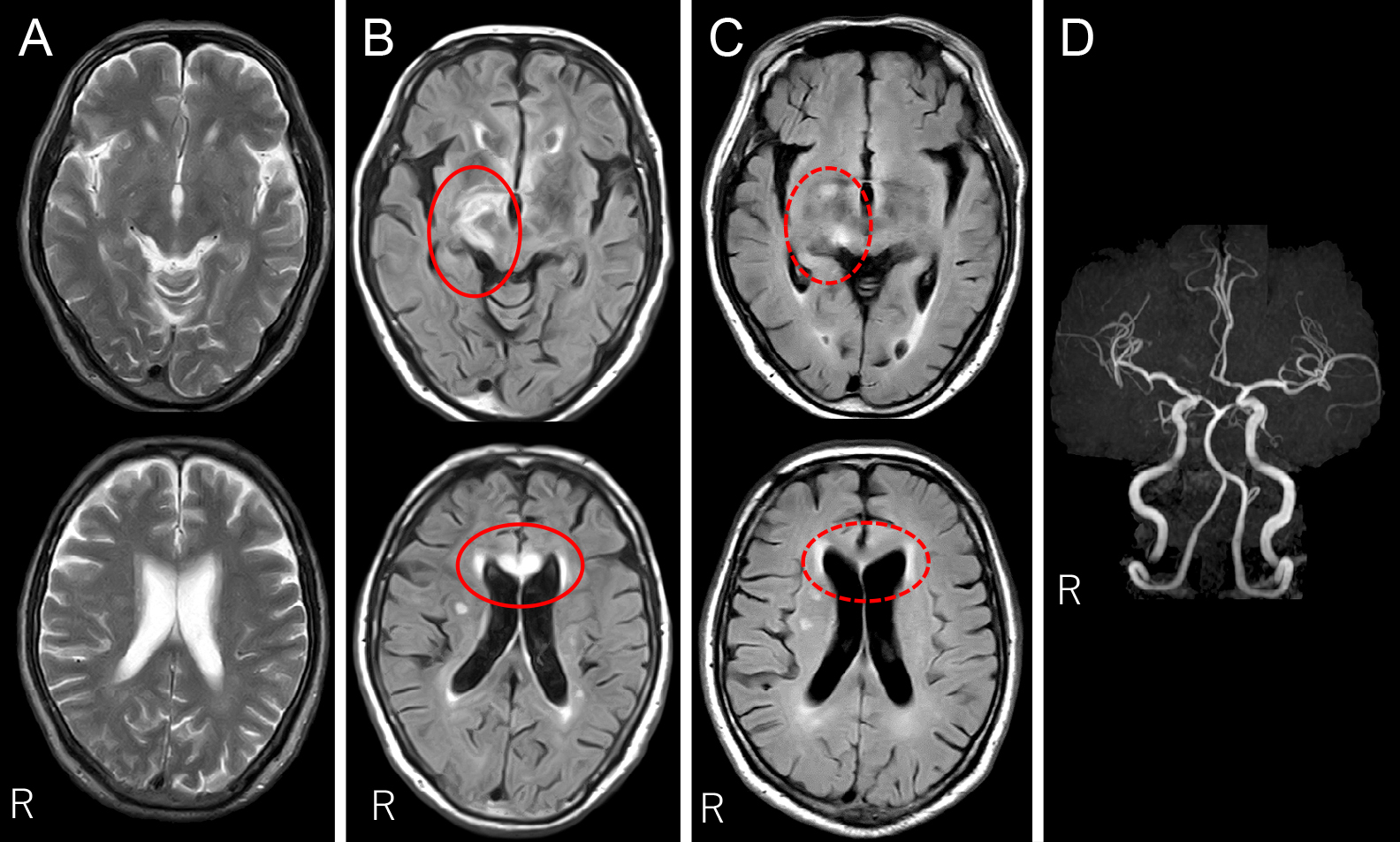 Vessel wall imagingで血管炎の活動性を追跡しえた治療抵抗性髄膜血管型梅毒の1例